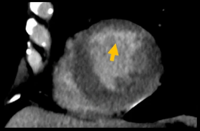 Late enhancement myocardial imaging