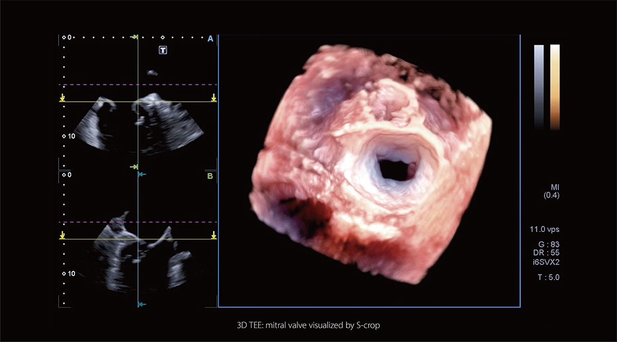 Structural heart disease