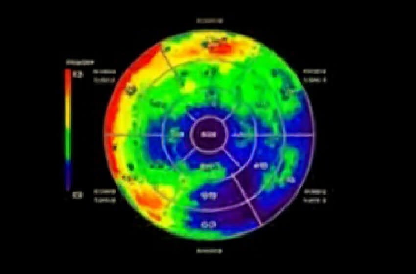 Advanced myocardial perfusion imaging