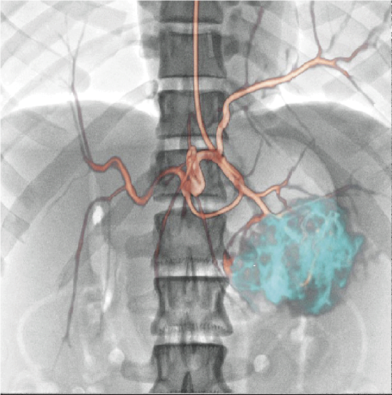 Angiography | Canon Medical Systems