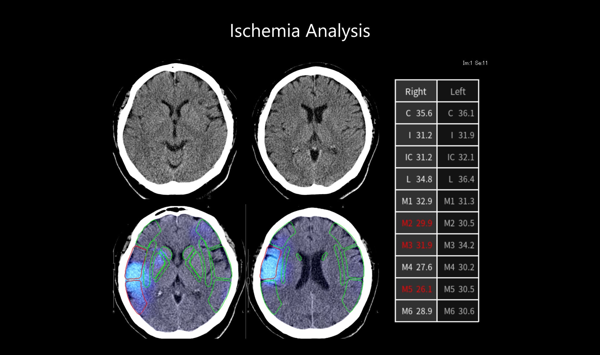 Ischemia Analysis