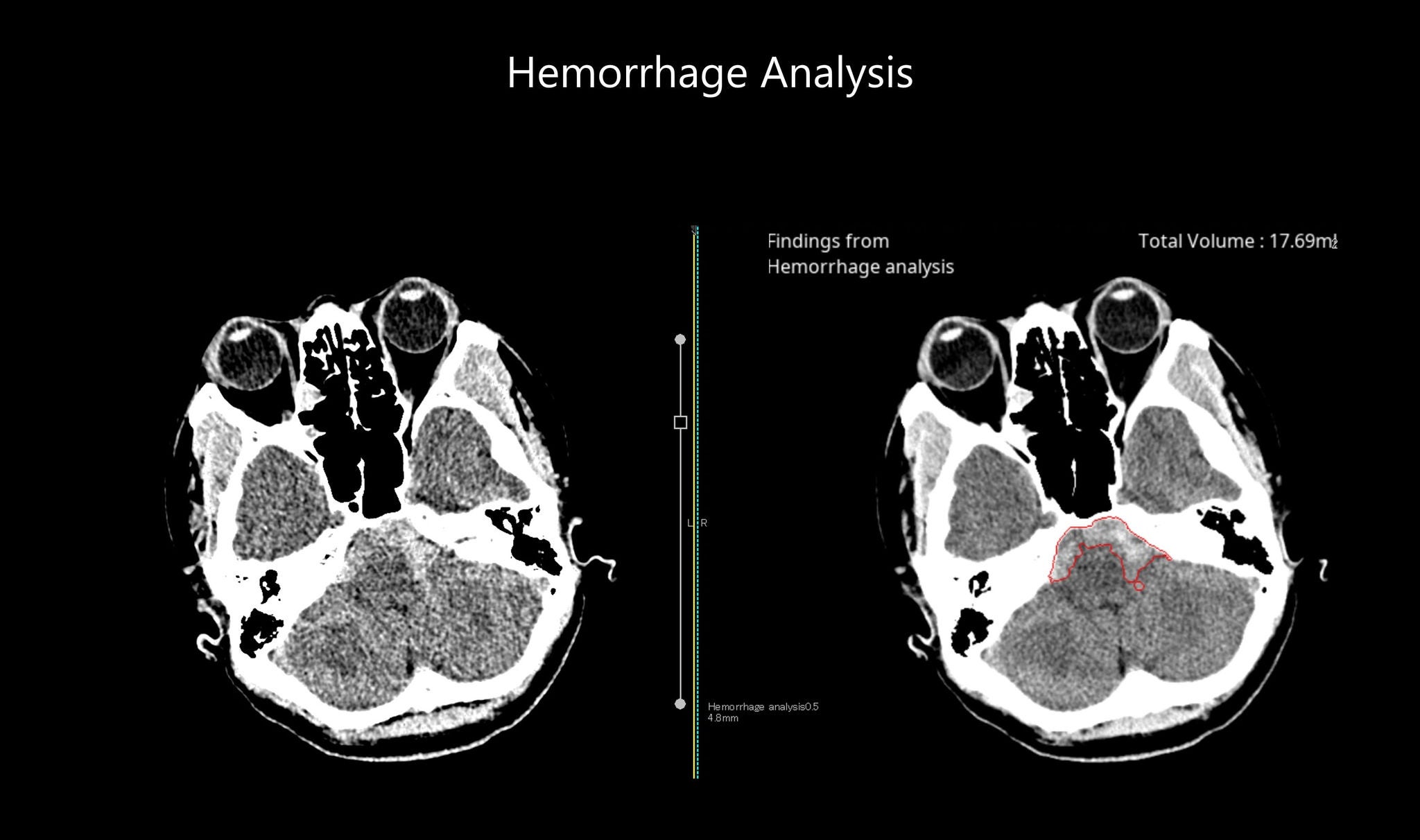 Hemorrhage Analysis