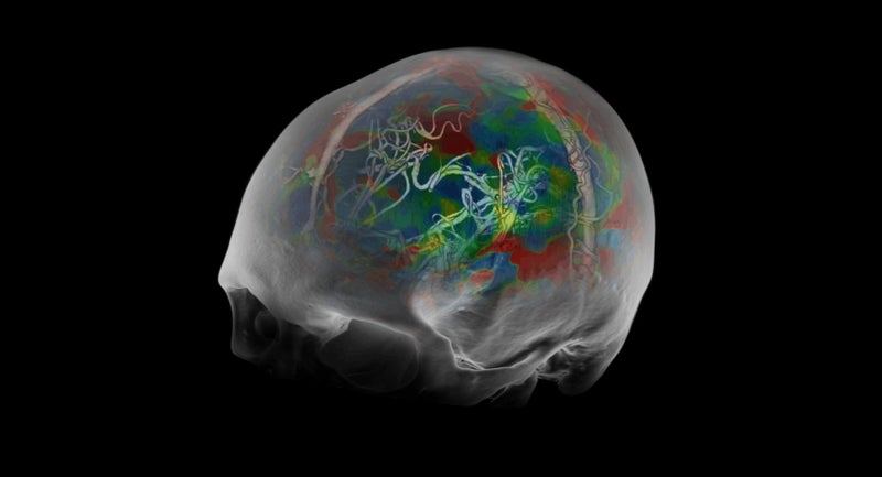 CT Brain Perfusion | Clinical Application Video | Clinical Applications ...