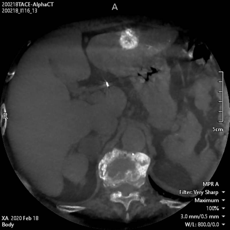 Alphenix Abdominal Alpha CT