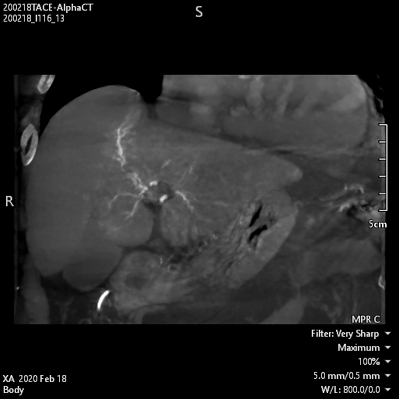 Alphenix Abdominal Alpha CT