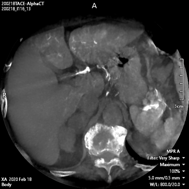 Alphenix Abdominal Alpha CT