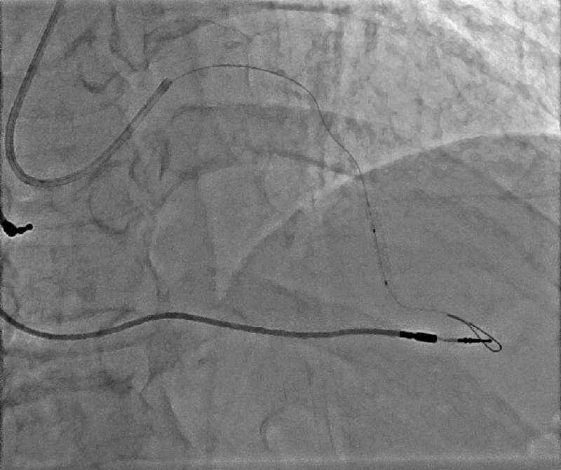 PCI