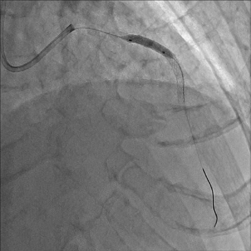 PCI
