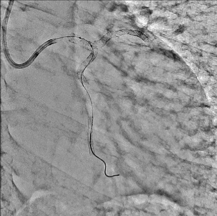 PCI
