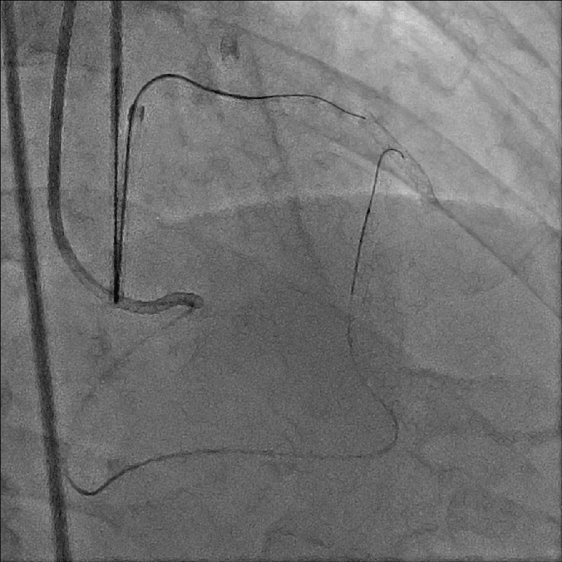 PCI