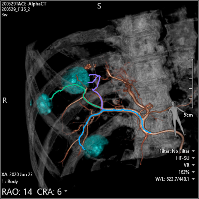 Alphenix Embolization Plan