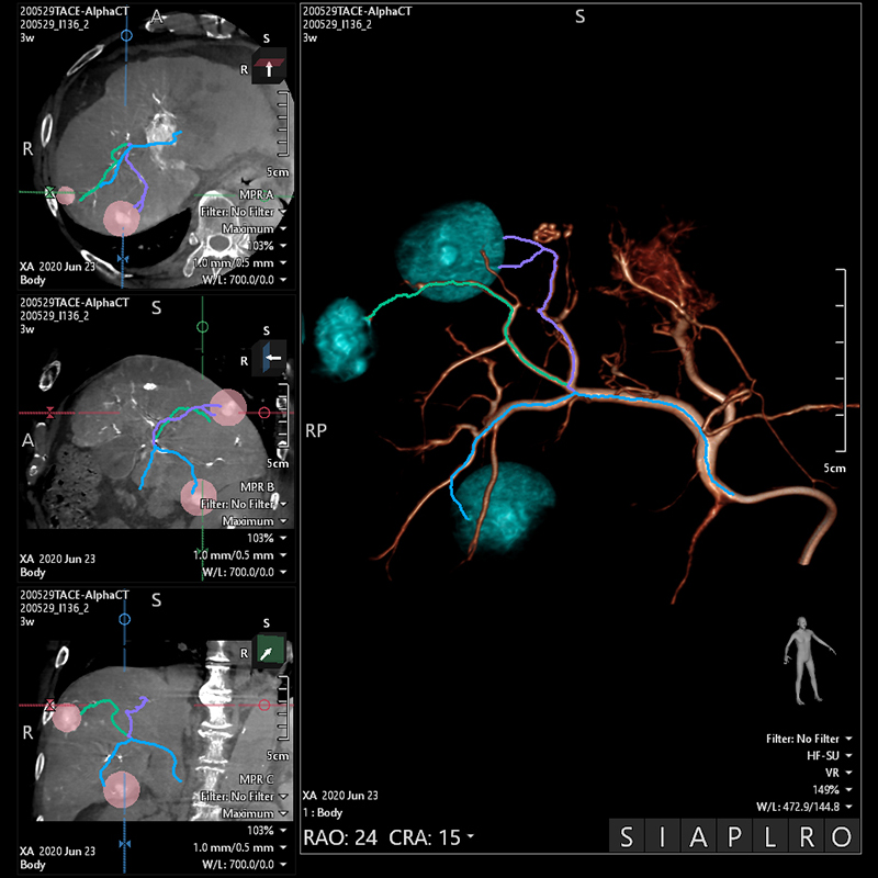 Alphenix Embolization Plan