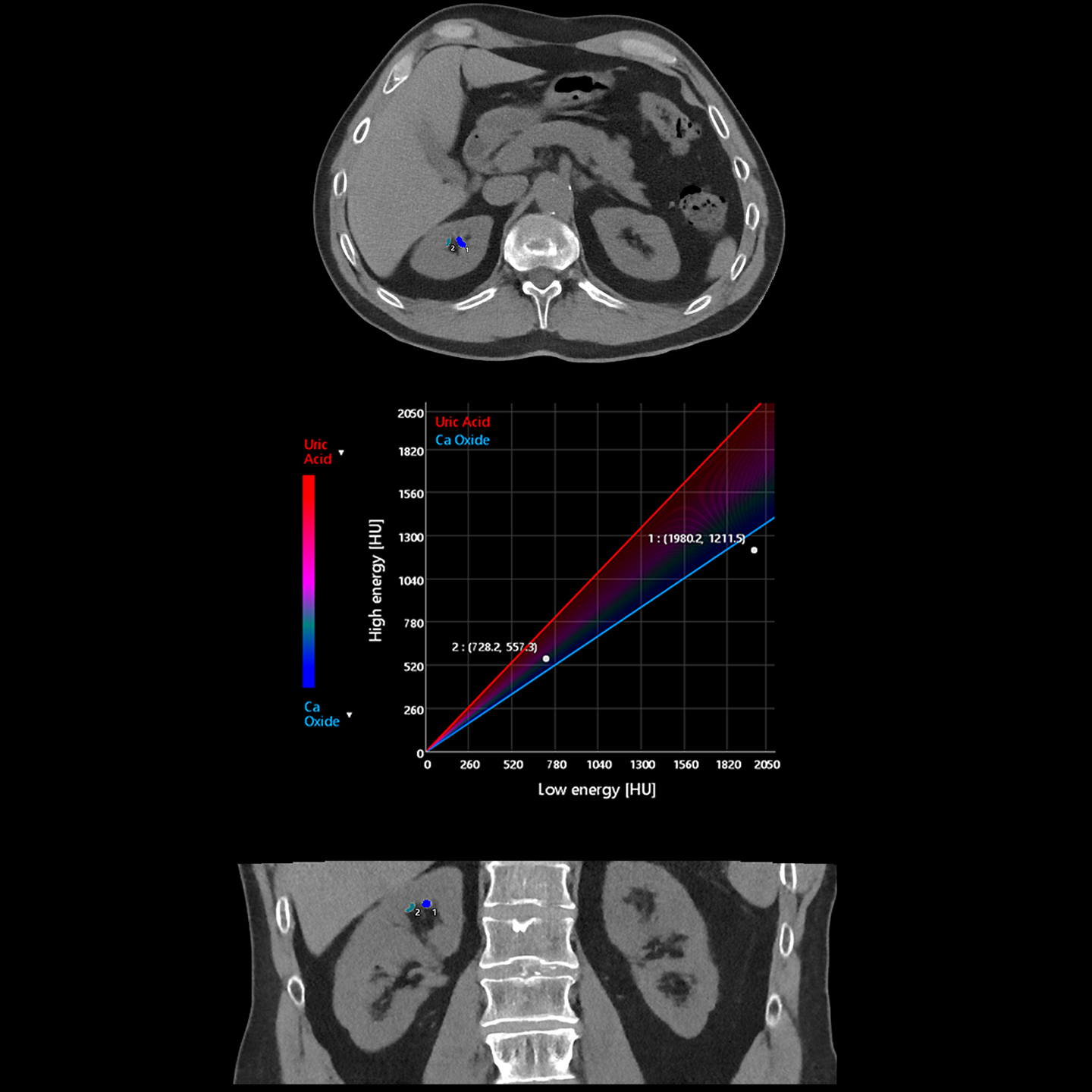 Aquilion ONE / PRISM Edition Kidney Stone Analysis