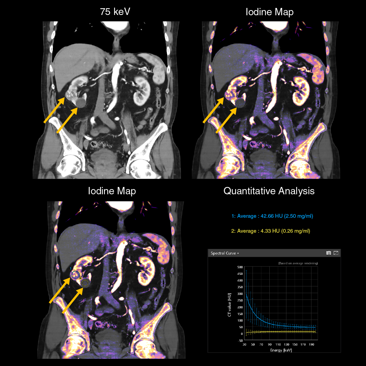 Aquilion ONE / PRISM Edition Kidney tumor