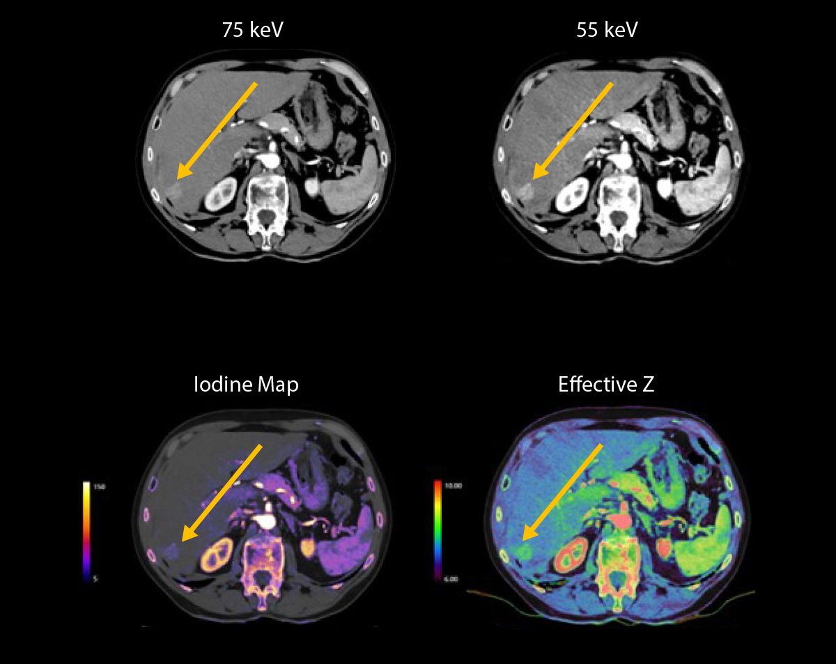 Aquilion ONE / PRISM Edition Hypervascular liver lesion