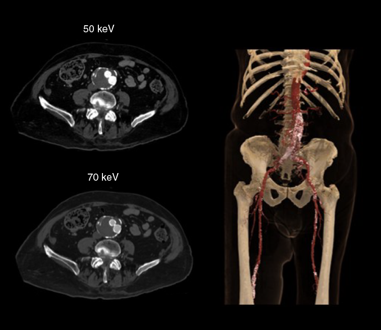 Aquilion ONE / PRISM Edition Aorta CTA with reduced contrast dose
