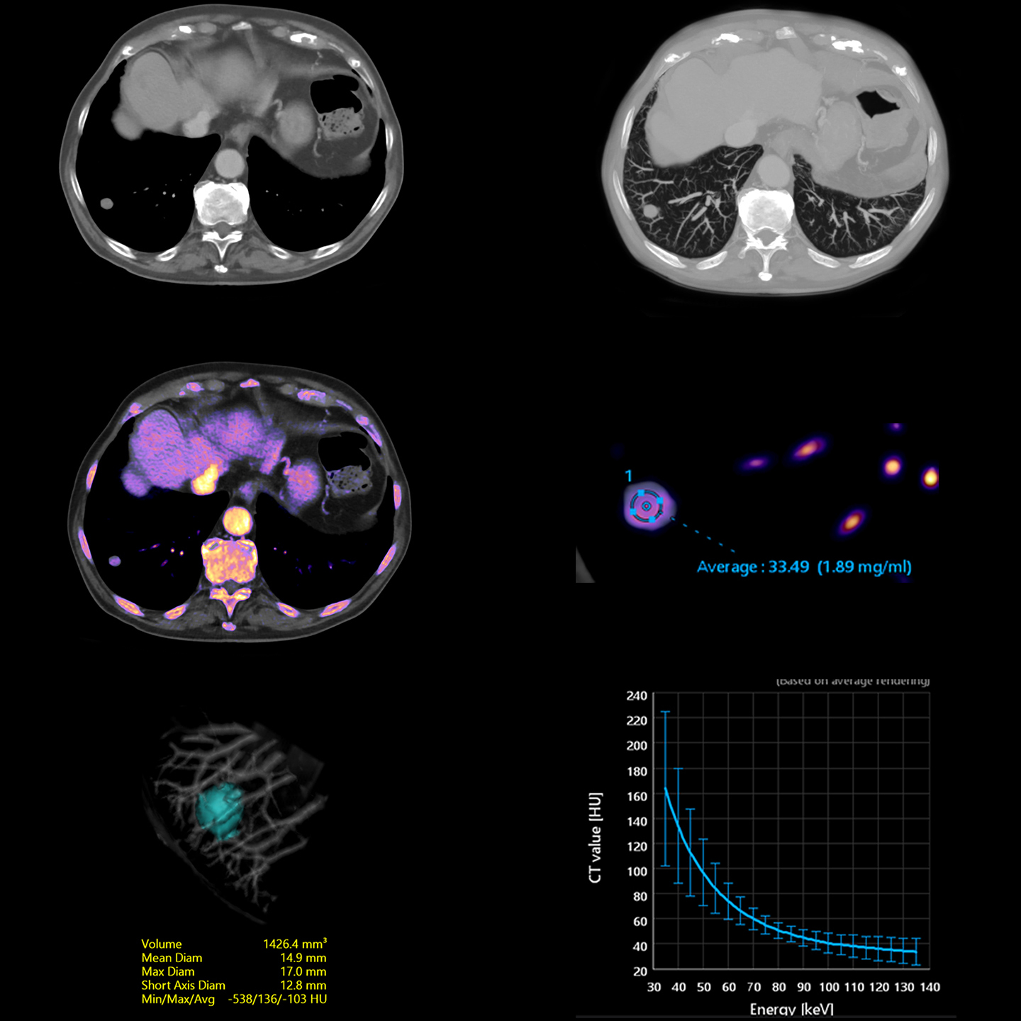 Aquilion ONE / PRISM Edition Lung Nodule — Iodine Map Analysis