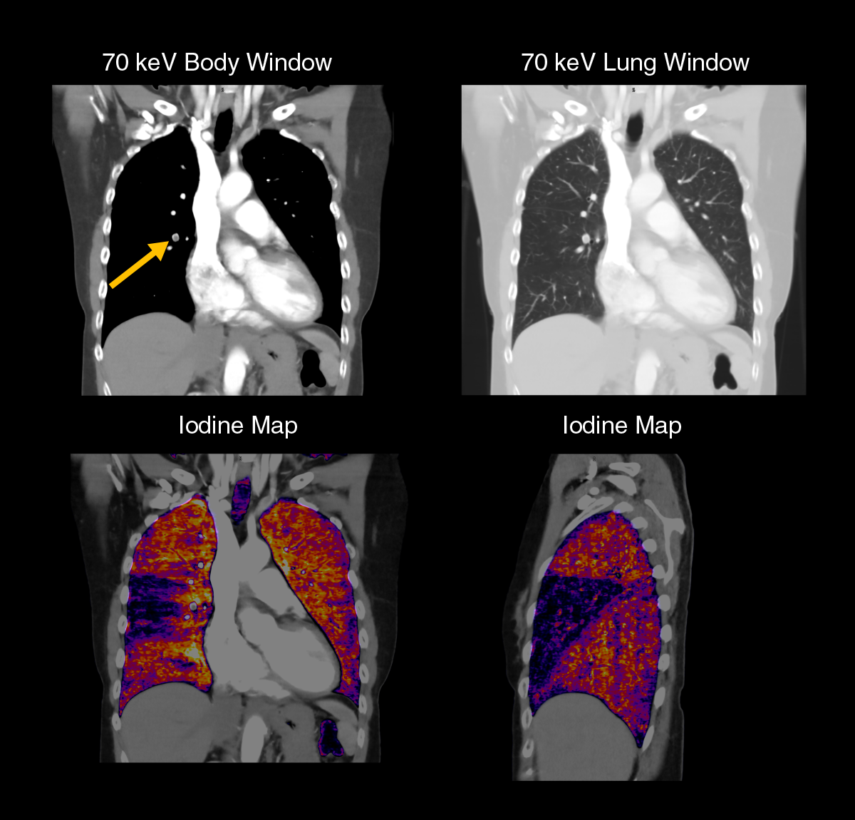 Aquilion ONE / PRISM Edition Spectral pulmonary embolism