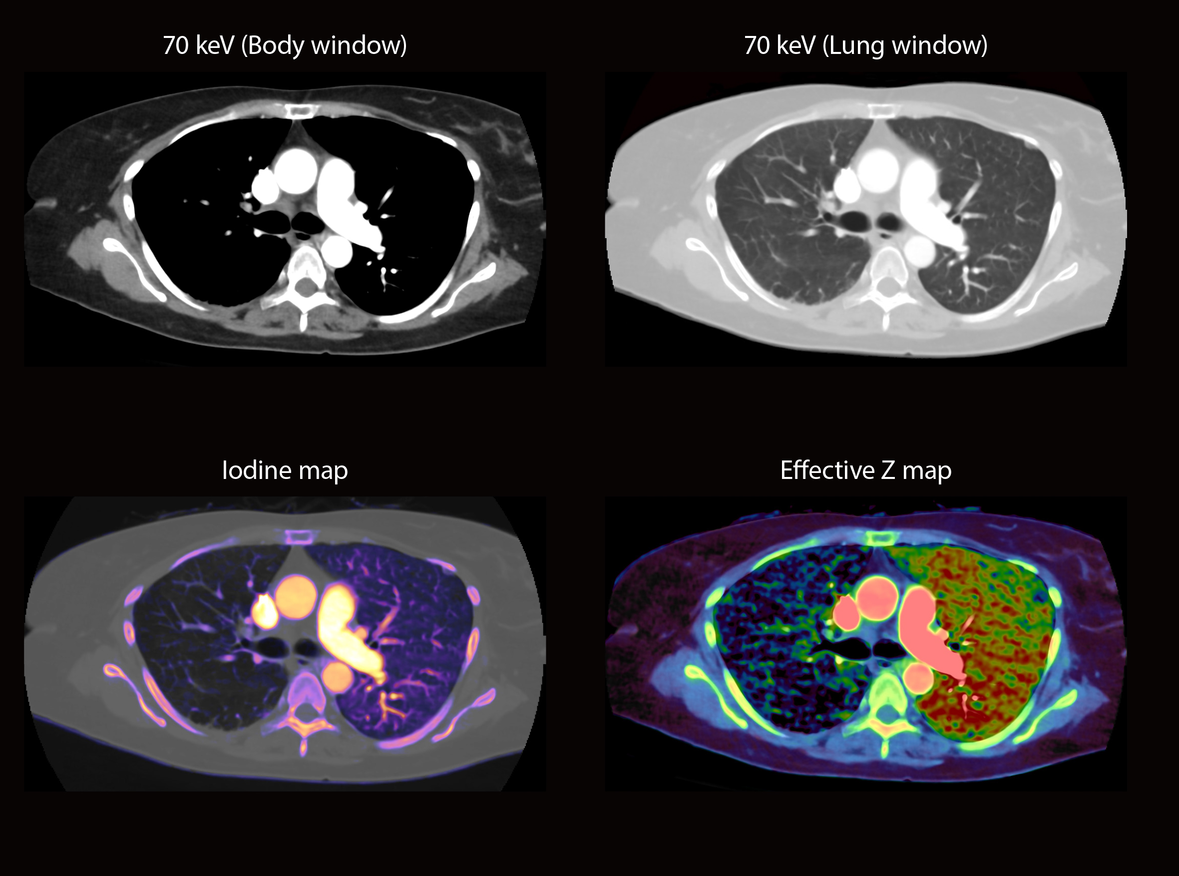 Aquilion ONE / PRISM Edition Congenital absence of right pulmonary artery