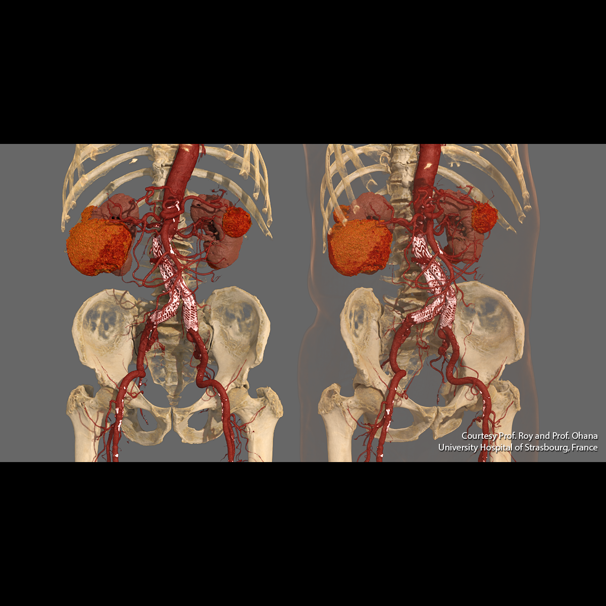 Global Illumination Abdomen