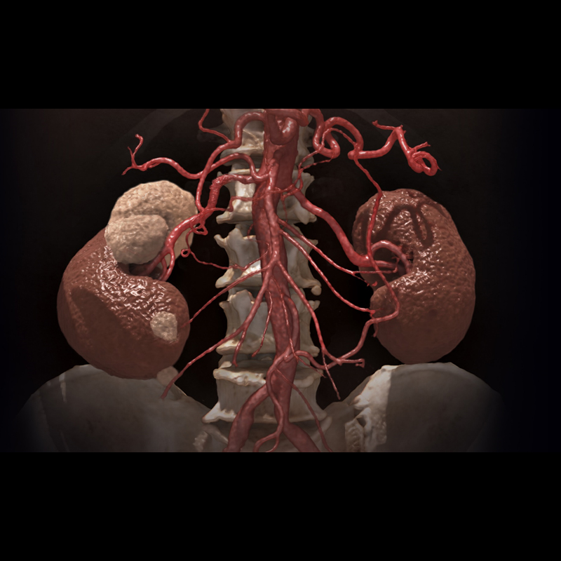 Global Illumination Abdomen