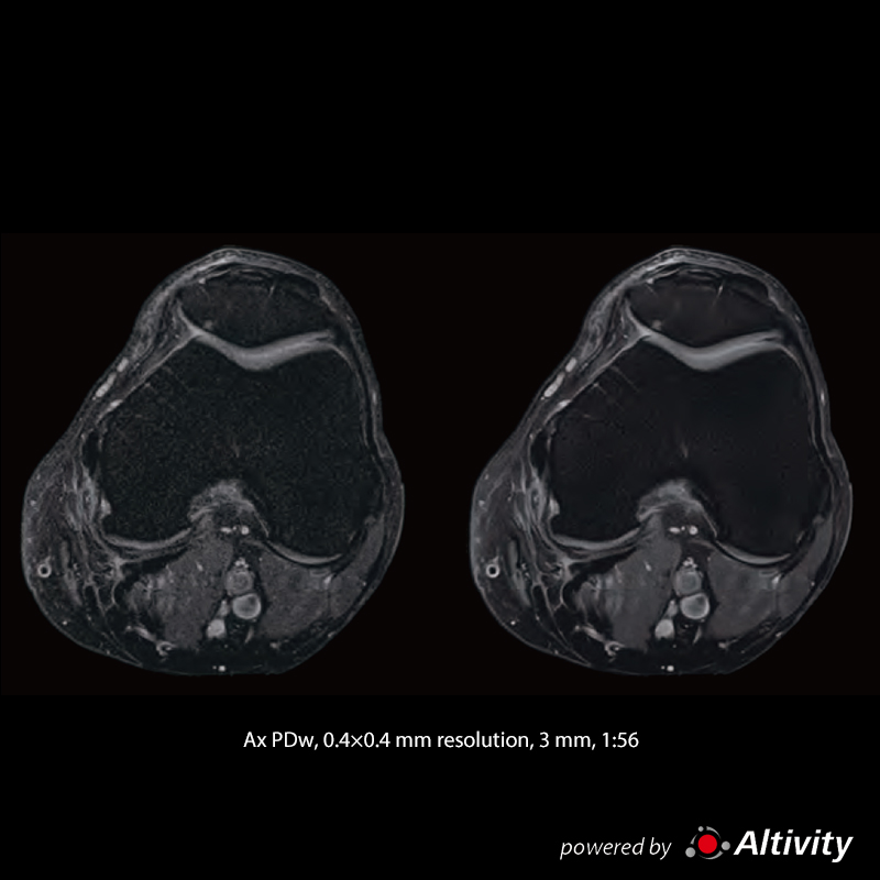 Vantage Fortian High-resolution knee images