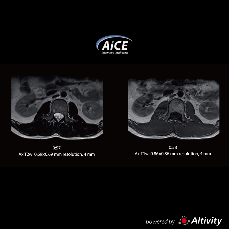 Vantage Fortian Fast routine L-spine examination