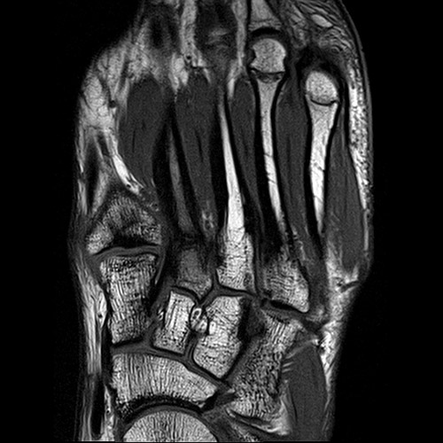 SportsMed Foot MRI // Bone fracture