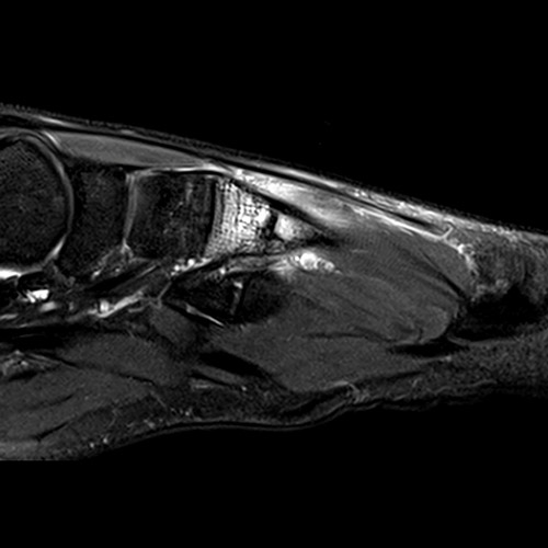 SportsMed Foot MRI // Bone fracture
