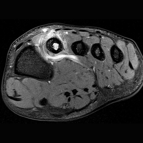 SportsMed Foot MRI // Bone fracture