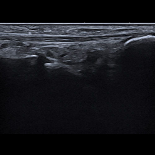 SportsMed Foot Ultrasound // Peroneus Brevis tendon