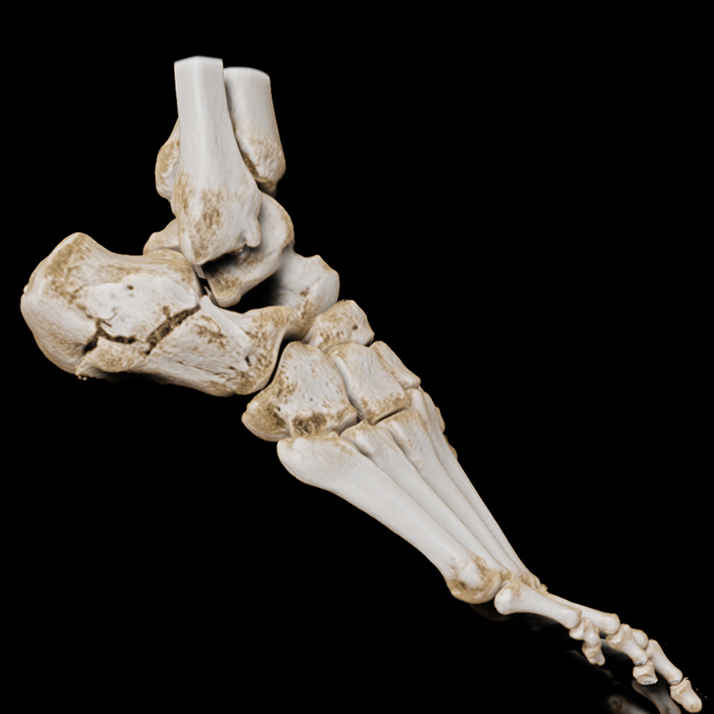 SportsMed Foot CT// Calcaneus fracture