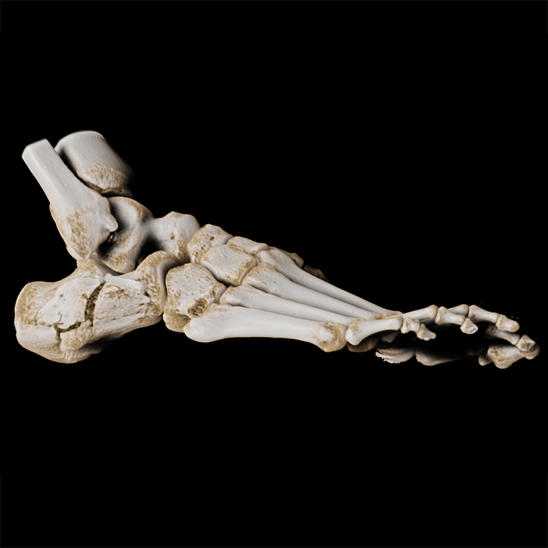 SportsMed Foot CT// Calcaneus fracture