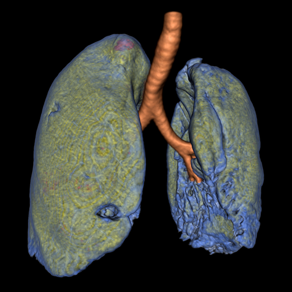 AIDR3D Ultra Low Dose Chest