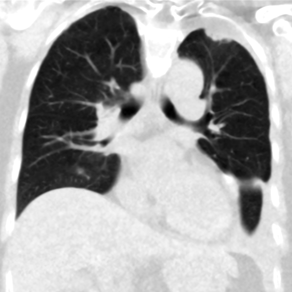 AIDR3D Ultra Low Dose Chest