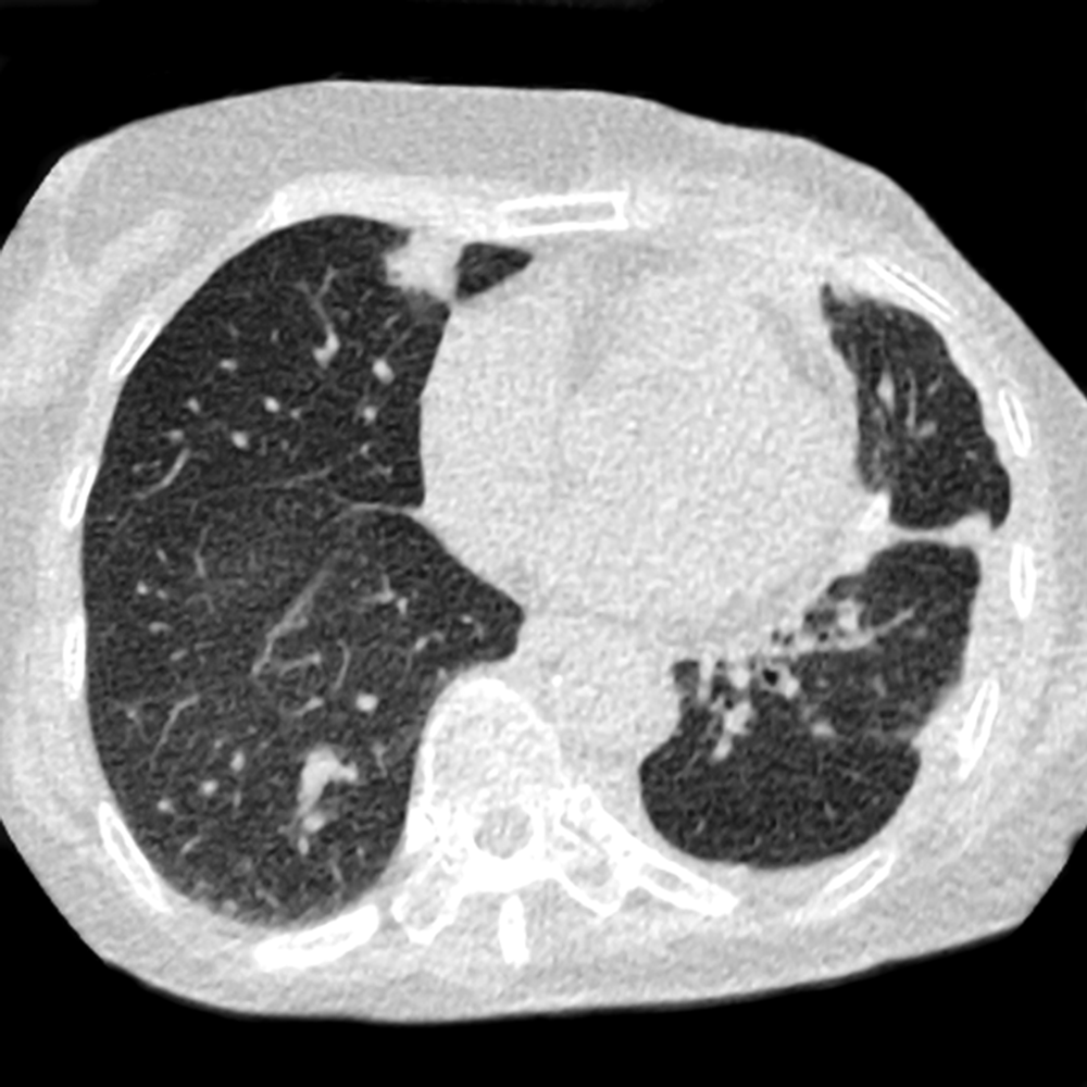 AIDR3D Ultra Low Dose Chest