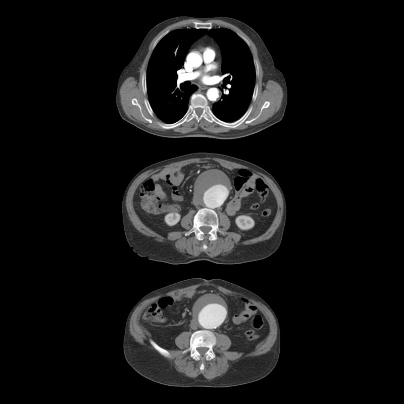 Aquilion Lightning 80 Whole Aorta CTA