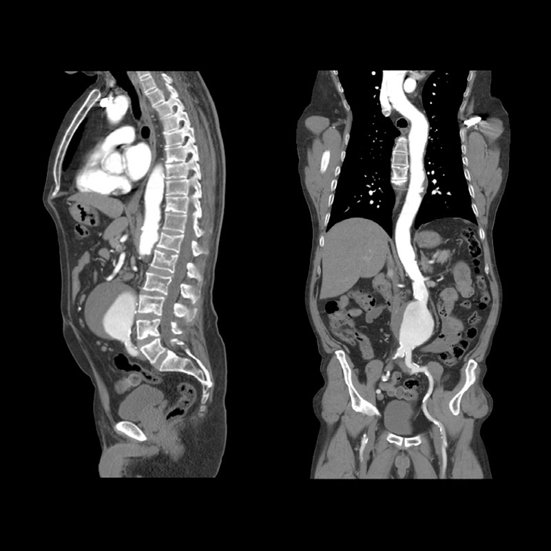 Aquilion Lightning 80 Whole Aorta CTA