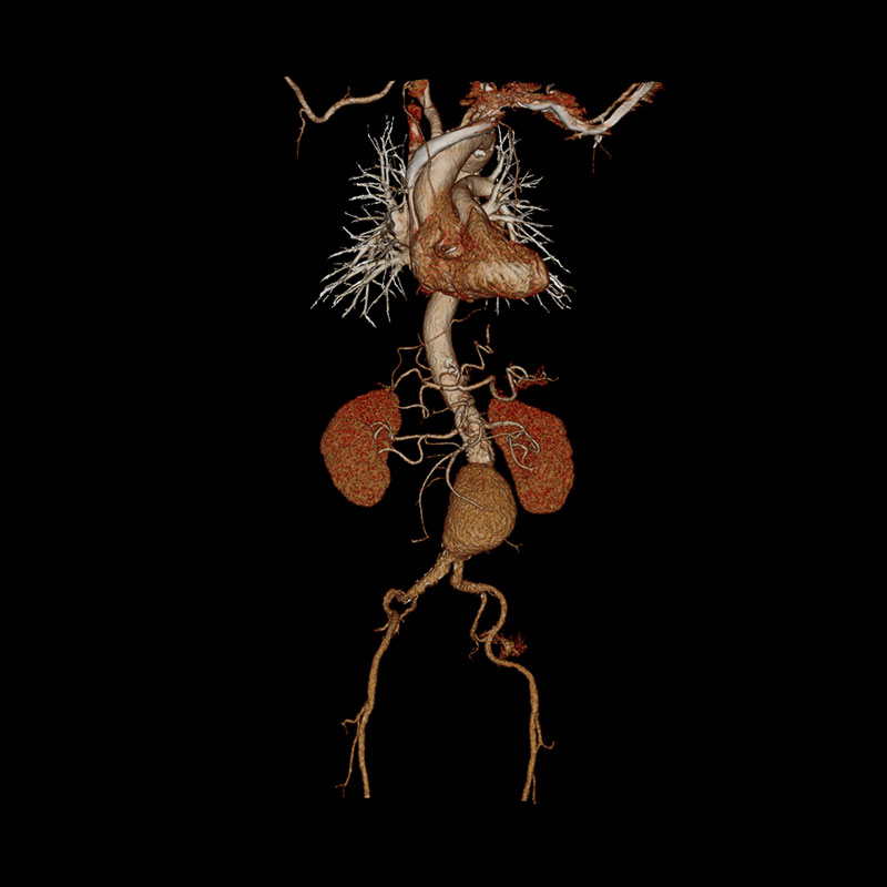 Aquilion Lightning 80 Whole Aorta CTA