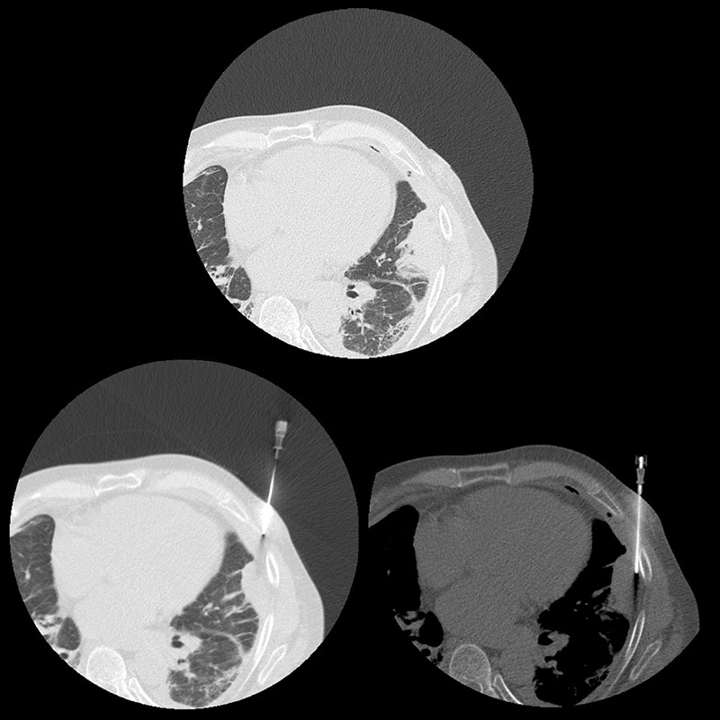 Aquilion Lightning 80 CT Lung Biopsy