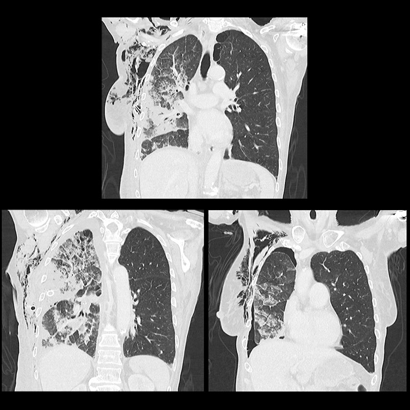 Aquilion Lightning 80 MVA, Pneumothorax