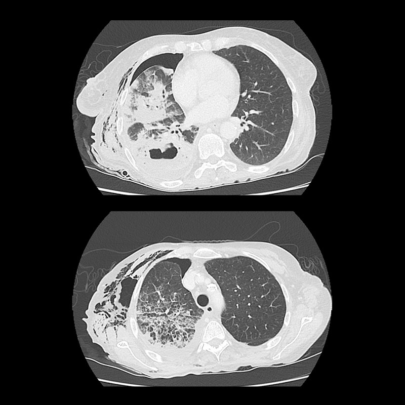 Aquilion Lightning 80 MVA, Pneumothorax