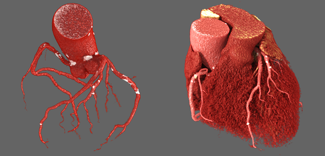 Aquilion Lightning 80 Cardiac - 3 vessel disease