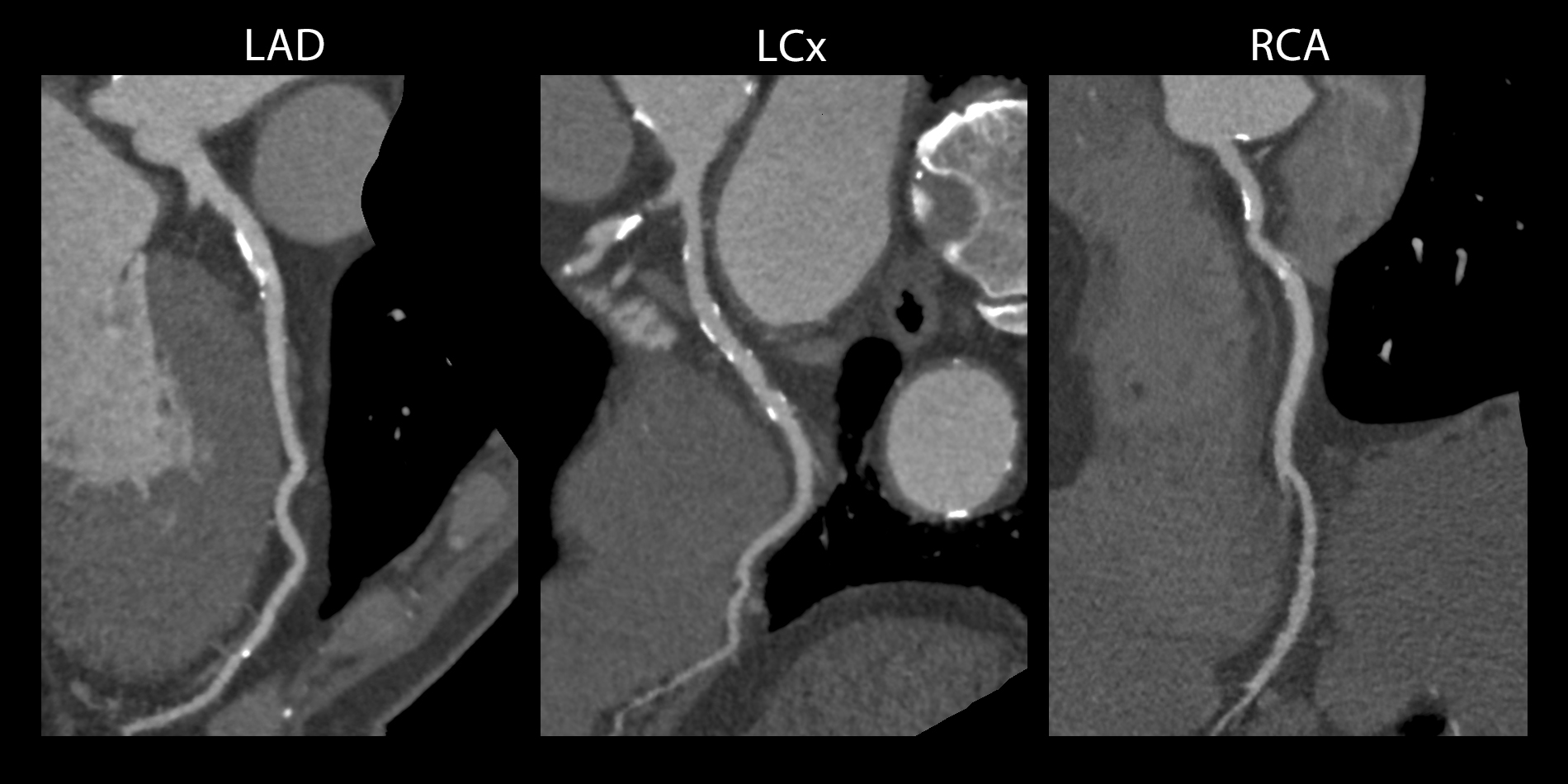 Aquilion Lightning 80 Cardiac - 3 vessel disease