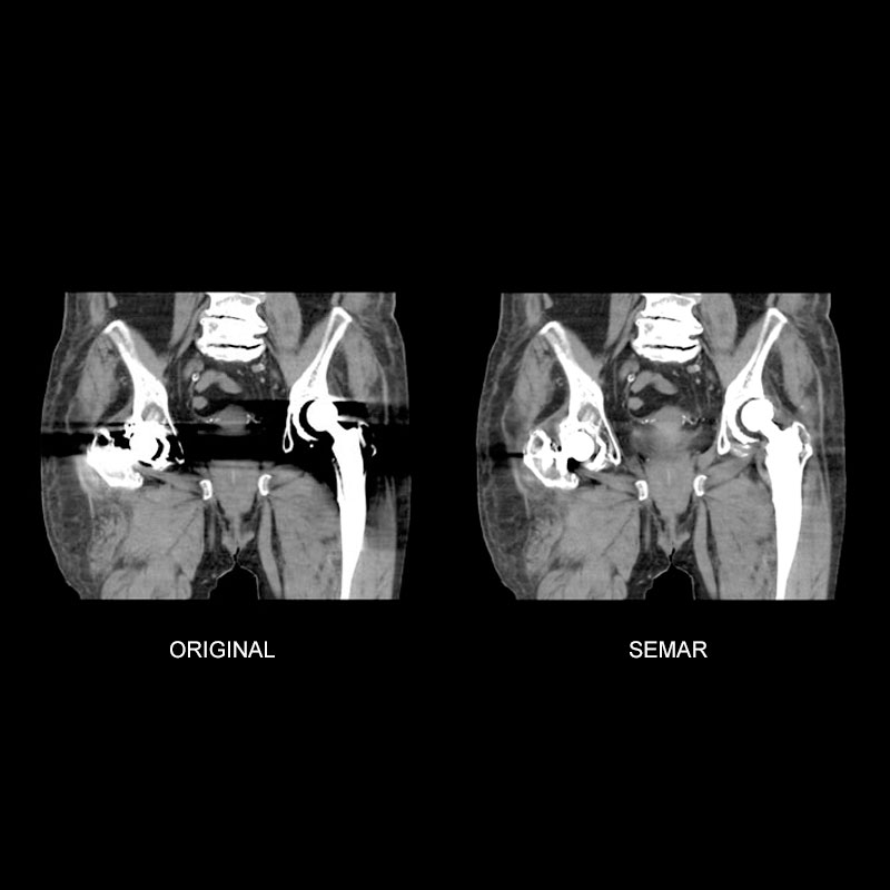 Aquilion Lightning 80 Pelvis with SEMAR