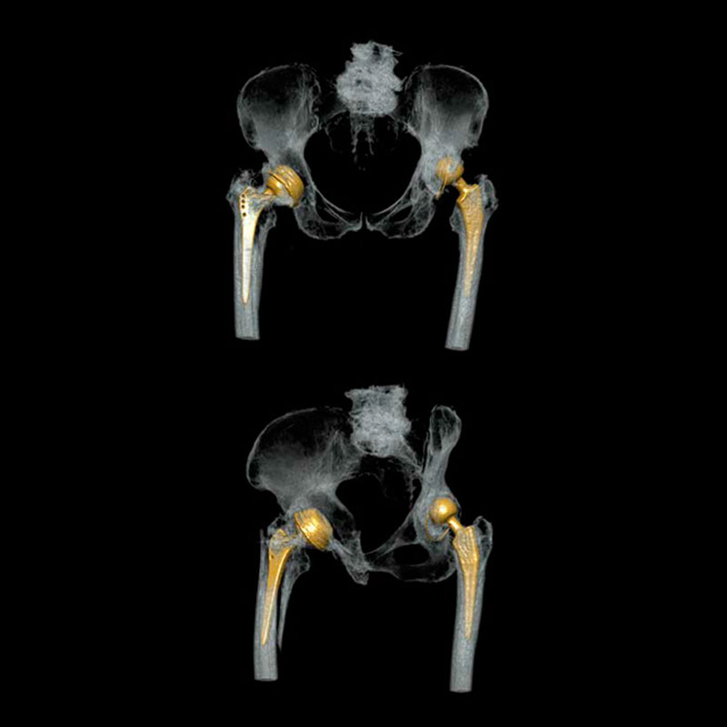 Aquilion Lightning 80 Pelvis with SEMAR