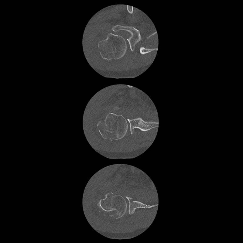 Aquilion Lightning 80 Right Shoulder