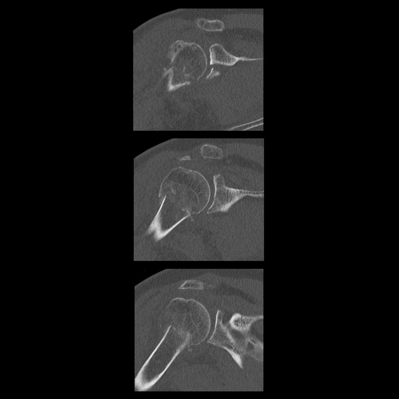 Aquilion Lightning 80 Right Shoulder
