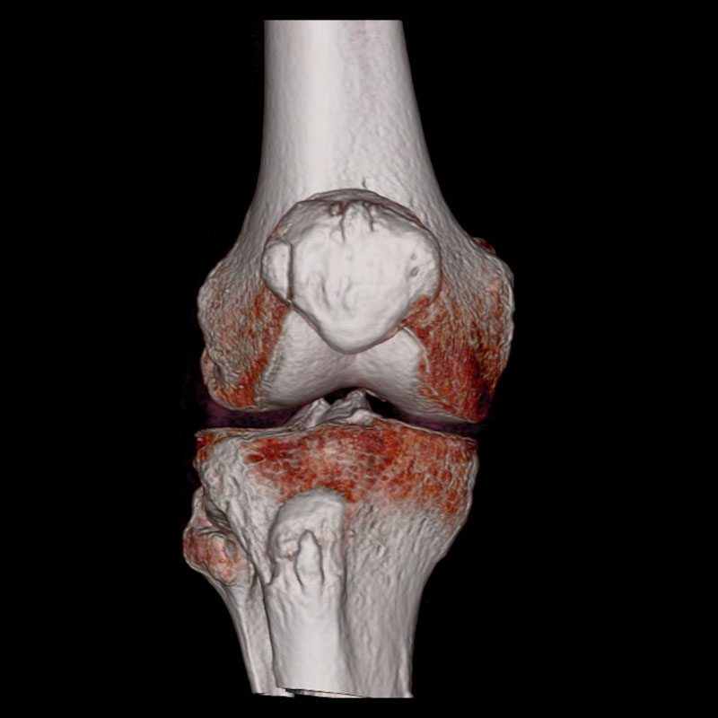 Aquilion Lightning 80 Vertical Patella Fracture