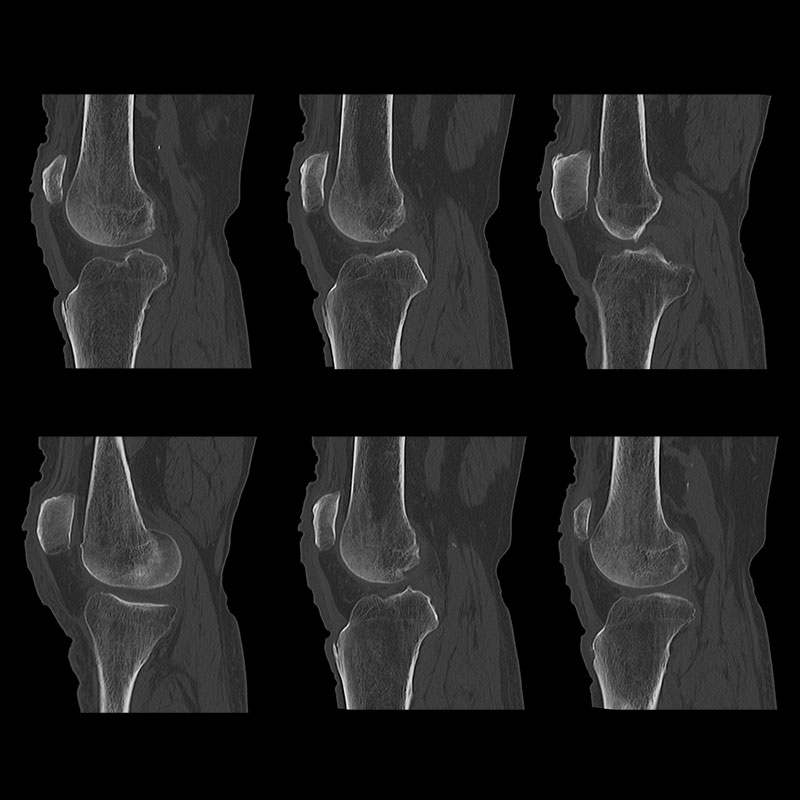 Aquilion Lightning 80 Vertical Patella Fracture